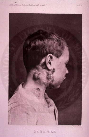 Scrofula